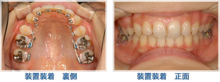 最新の舌側矯正治療（裏側矯正）